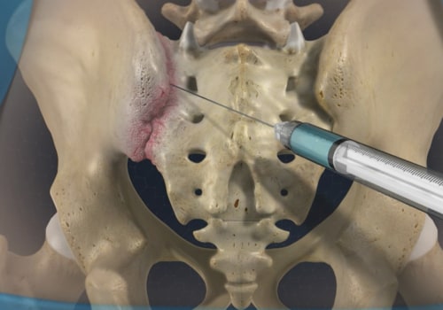 How Long Does It Take for Facet Joint Injections to Start Working?