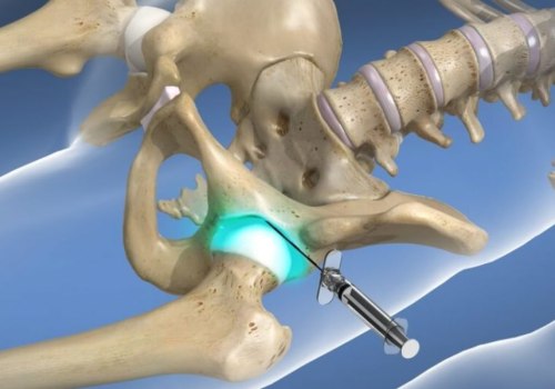 Can I Walk After Facet Joint Injections?